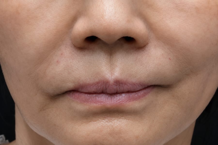 After Skin booster injection — overall texture, LUNN Dermatology Clinic (룬피부과의원)