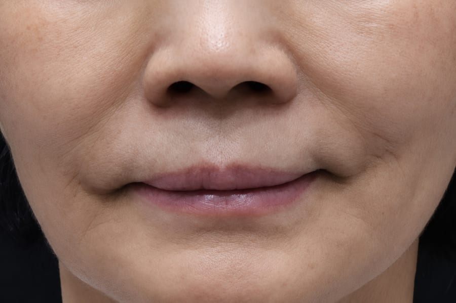 Before Skin booster injection — overall texture, LUNN Dermatology Clinic (룬피부과의원)