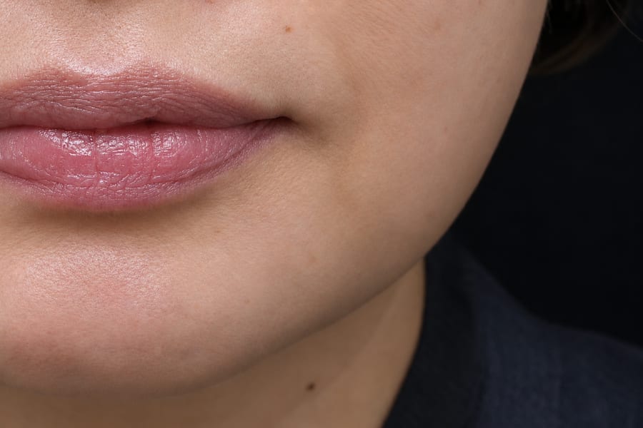 After Collagen stimulator injection — midface volume, LUNN Dermatology Clinic (룬피부과의원)