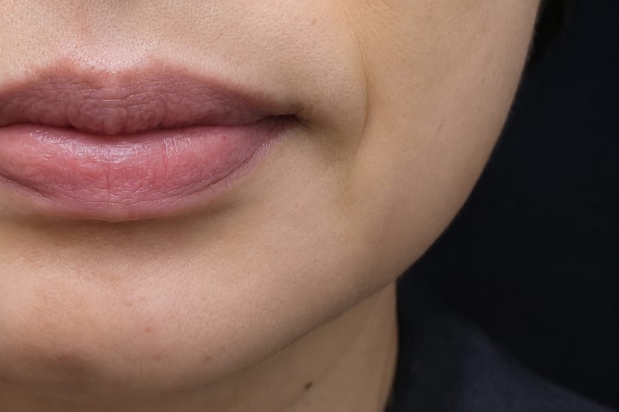 Before Collagen stimulator injection — midface volume, LUNN Dermatology Clinic (룬피부과의원)