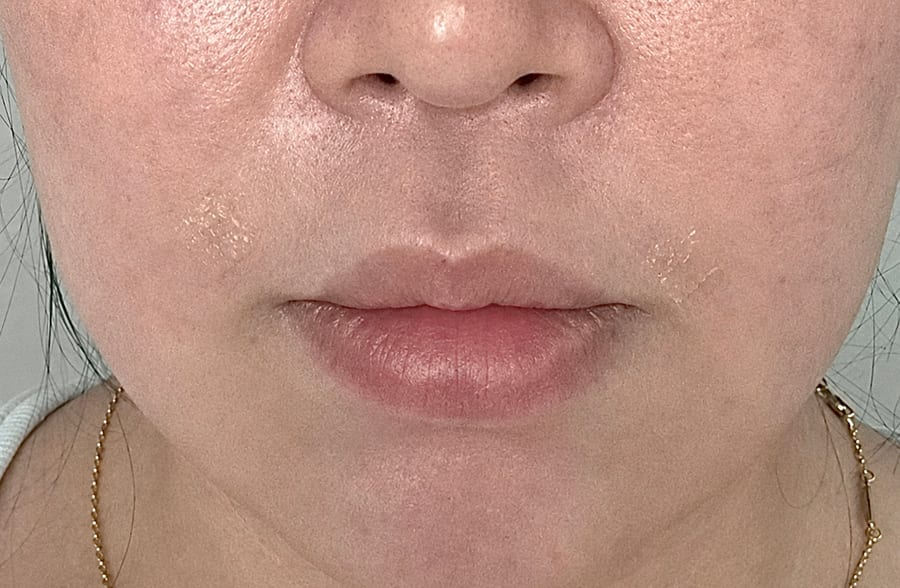 After Hyaluronic acid filler — nasolabial folds, LUNN Dermatology Clinic (룬피부과의원)