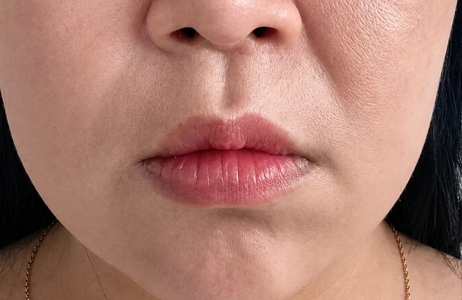 Before Hyaluronic acid filler — nasolabial folds, LUNN Dermatology Clinic (룬피부과의원)