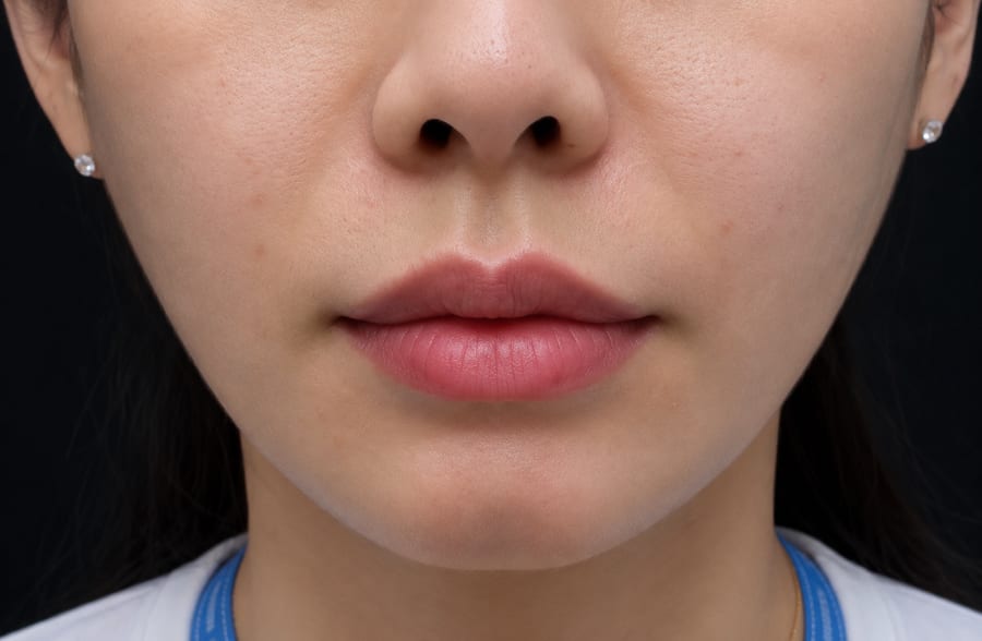 Before Juvelook Volume (PDLLA) — midface, LUNN Dermatology Clinic (룬피부과의원)