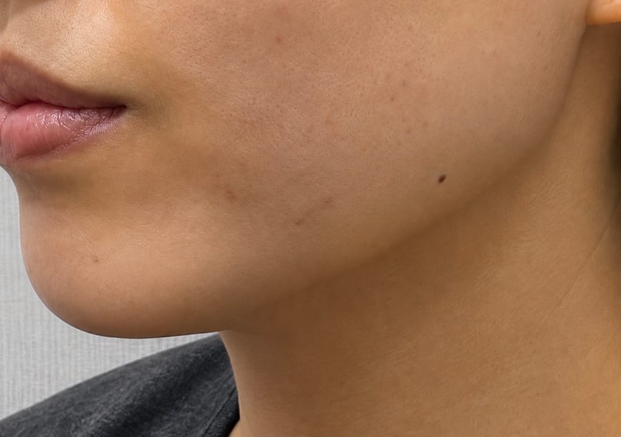 After Onda — lower face and jawline, LUNN Dermatology Clinic (룬피부과의원)