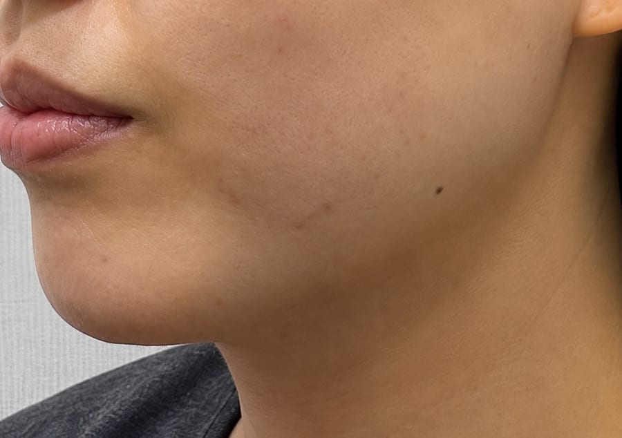 Before Onda — lower face and jawline, LUNN Dermatology Clinic (룬피부과의원)