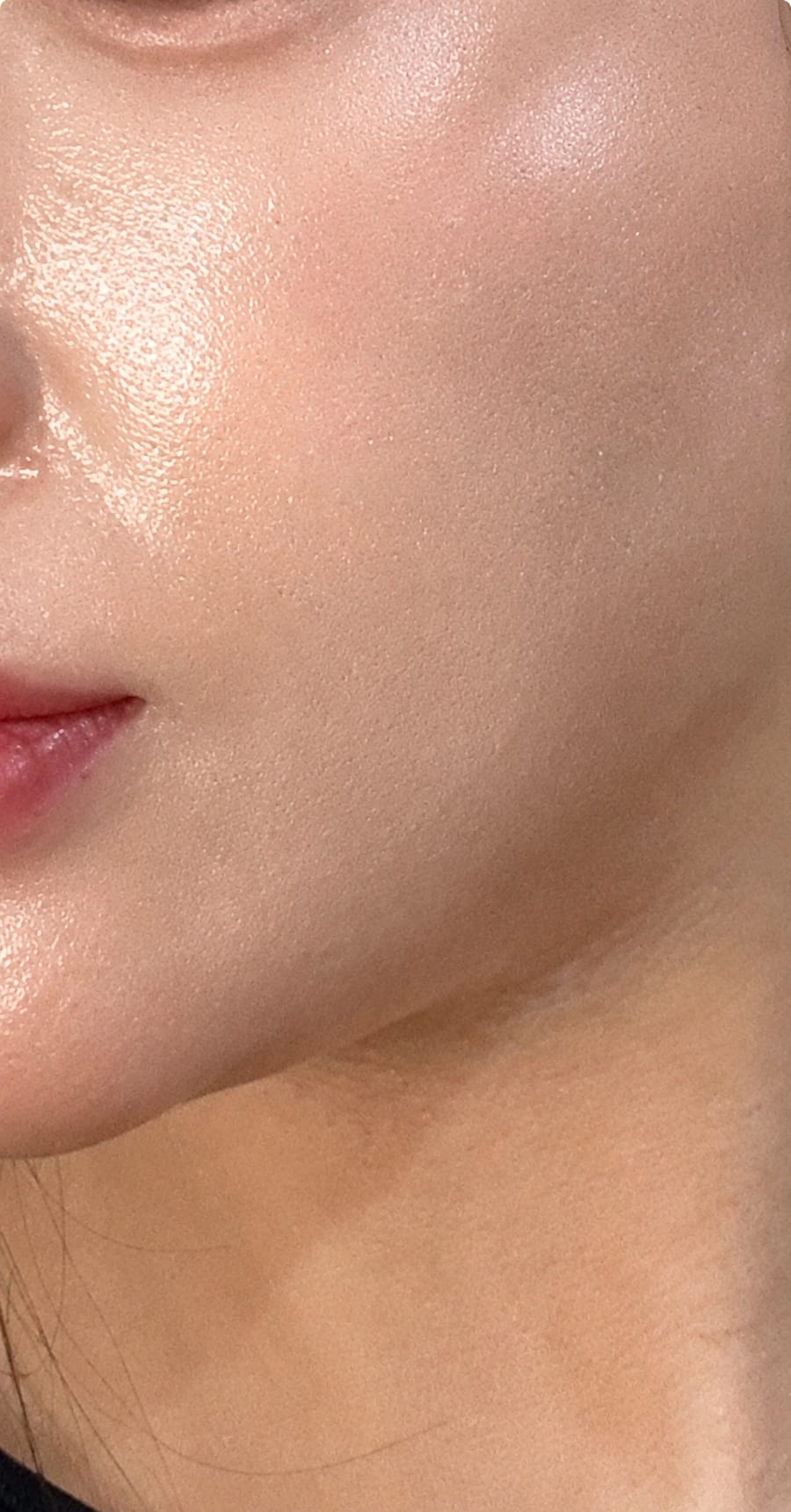 After Pico Fraxel — cheek pores and pigment, LUNN Dermatology Clinic (룬피부과의원)