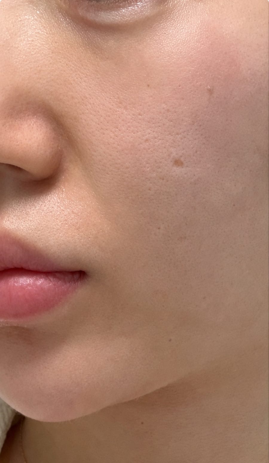Before Pico Fraxel — cheek pores and pigment, LUNN Dermatology Clinic (룬피부과의원)