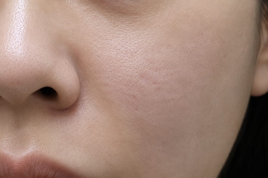 After Pico Fraxel — cheek pores and texture, LUNN Dermatology Clinic (룬피부과의원)