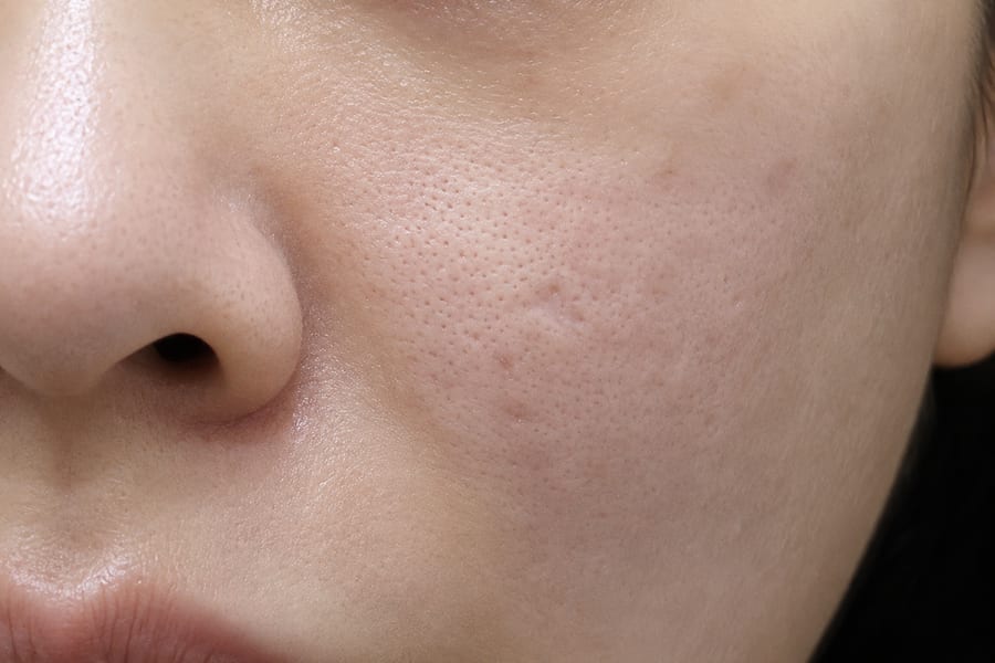 Before Pico Fraxel — cheek pores and texture, LUNN Dermatology Clinic (룬피부과의원)