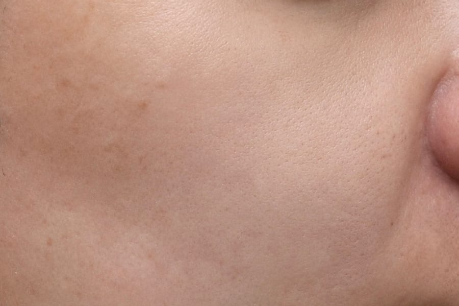 After Skin botox — cheek pores and fine texture, LUNN Dermatology Clinic (룬피부과의원)