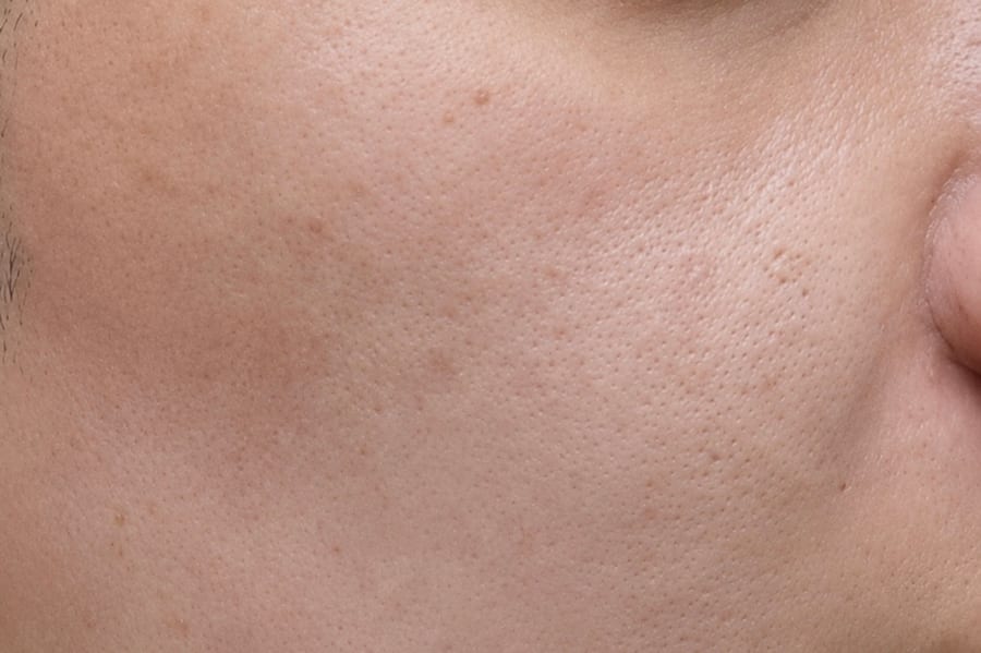 Before Skin botox — cheek pores and fine texture, LUNN Dermatology Clinic (룬피부과의원)