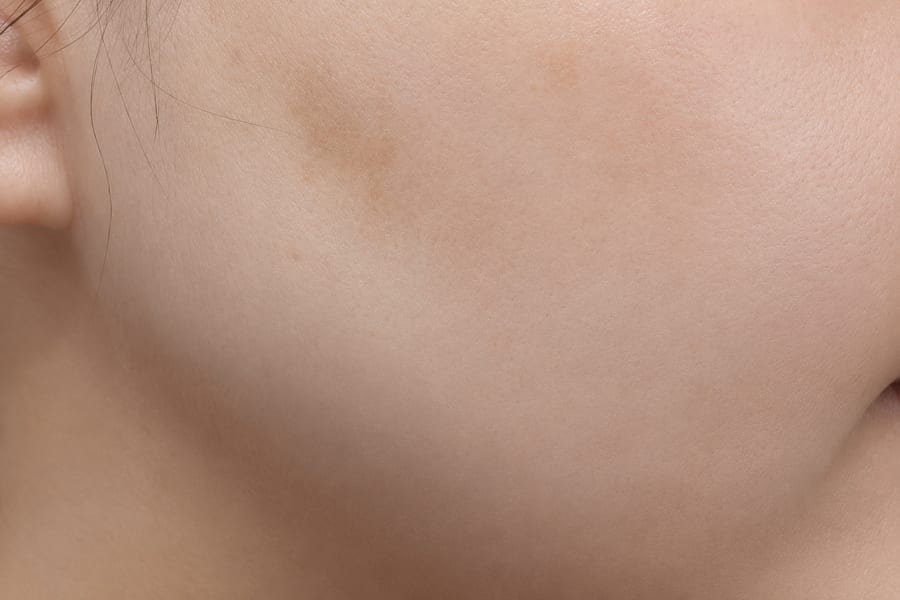 After In-clinic skincare programme — barrier and texture, LUNN Dermatology Clinic (룬피부과의원)