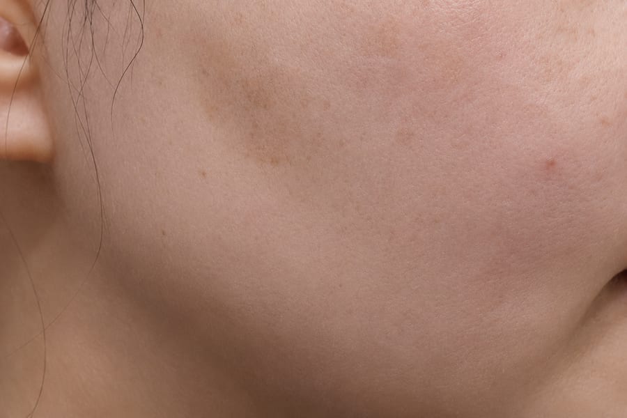 Before In-clinic skincare programme — barrier and texture, LUNN Dermatology Clinic (룬피부과의원)