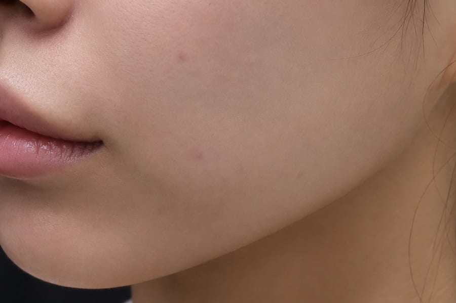 After Sofwave — jawline and lower face, LUNN Dermatology Clinic (룬피부과의원)