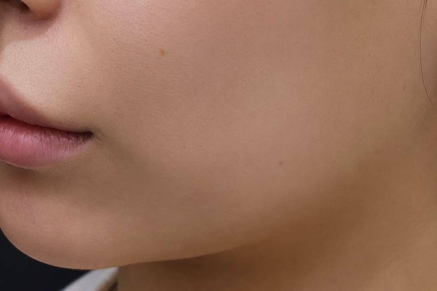 Before Sofwave — jawline and lower face, LUNN Dermatology Clinic (룬피부과의원)