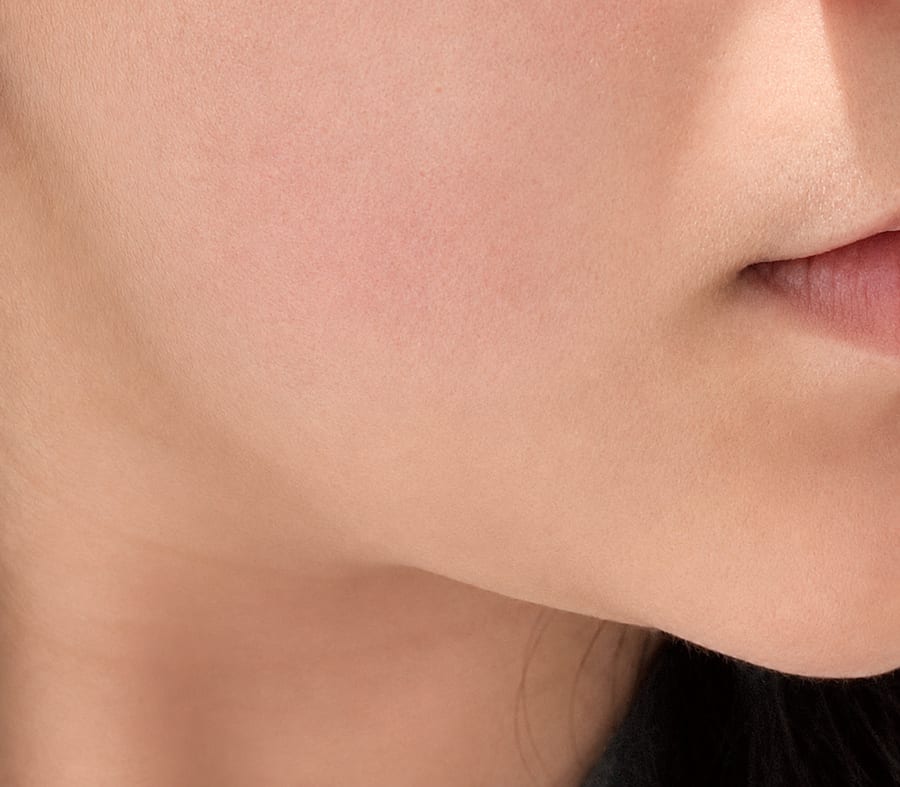 After Ulthera and Thermage — lower face, LUNN Dermatology Clinic (룬피부과의원)