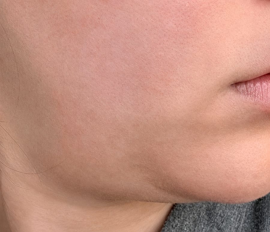 Before Ulthera and Thermage — lower face, LUNN Dermatology Clinic (룬피부과의원)